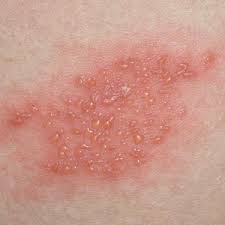 Untreated lyme disease can cause serious complications over time, including joint pain and meningitis. The Diagnosis And Management Of Herpes Zoster Bpj 59 March 2014