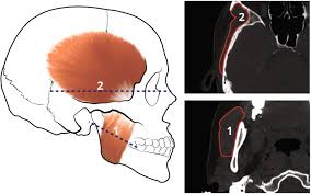 The area of one such thin slice, made perpendicular. Human Mandibular Shape Is Associated With Masticatory Muscle Force Scientific Reports