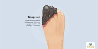 Check spelling or type a new query. Gangrene Tanda Dan Gejala Penyebab Cara Mengobati Cara Mencegah