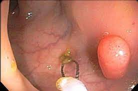 Most recent weekly top monthly top most viewed top rated longest. Anal Cancer Surgery Frequently Asked Question