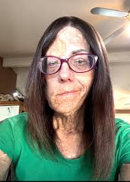 Hi everyone Sorry I've been quiet for couple of months. I have broken my  femur and hip and have been recovering. Currently sitting in the sun,  growing my leg and doodling. Colouring