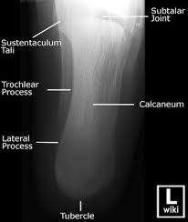 Image result for Calcaneus