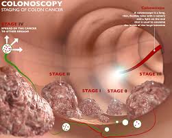 Treating Colon Cancer In The Elderly