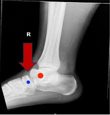 Image result for Subtalar Dislocation