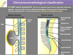Image result for Spinal Dysraphism