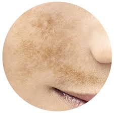 Resultado de imagem para manchas no rosto causadas pelo sol