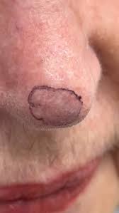Image result for skin cancer on nose pimple