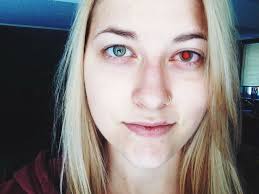 This is what happens when you have iritis & they only dilate one eye. :  r/pics