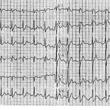 Camels' humps and their other adaptations have made them the preferred animal for desert travel for thousands of years, going places where no other vehicle or transport can go. Pdf Brugada Syndrome Report Of The Second Consensus Conference Endorsed By The Heart Rhythm Society And The European Heart Rhythm Association