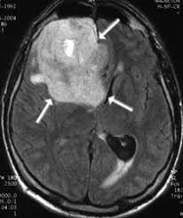 Klinik Und Poliklinik Fuer Neurochirurgie Gliome