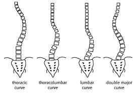 Scoliosis