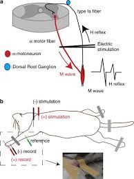 Hoffmann's reflex (hoffmann's sign, sometimes simply hoffmann's, also finger flexor reflex) is a neurological examination finding elicited by a reflex test which can help verify the presence or absence of issues arising from the corticospinal tract. Weakened Rate Dependent Depression Of Hoffmann S Reflex And Increased Motoneuron Hyperactivity After Motor Cortical Infarction In Mice Cell Death Disease