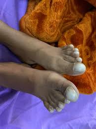 Image result for Clubbing nails feet