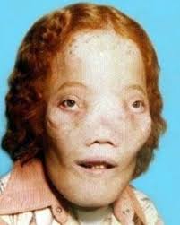 Rocky Dennis sống với rối loạn xương craniodiaphyseal, một rối loạn xương  khớp cực hiếm xảy ra trong khoảng một trong mỗi 220 triệu lần sinh, với ít  hơn 20 trường hợp