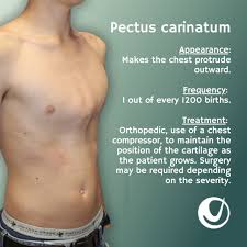 Image result for Pectus Excavatum