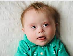 Pin On Down Syndrome Baby