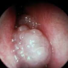 Steroid nasal drops are commonly. Endoscopic Image Of Nasal Polyps Download Scientific Diagram