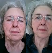 Led Light Therapy Stacey Austin Acupuncture