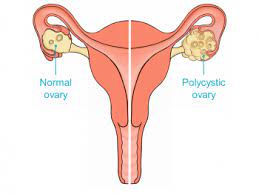 In fact, half of women with pcos get pregnant without any medical intervention. Pcos Treatment In Bangalore Polycystic Ovary Syndrome Diagnosis