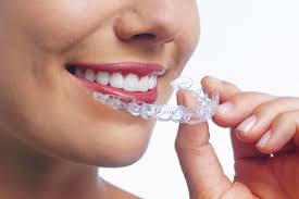 「lingual orthodontics」の画像検索結果