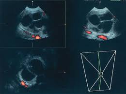 Your specialist may ask you to have a ct scan to show the ovaries more clearly. Diagnostic Ultrasound In The Assessment Of The Adnexal Mass Glowm