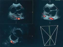 The tnm system can also be used, but transvaginal ultrasound (tvuss) is very useful in detecting ovarian cysts and assessing their malignant potential, but requires specialist sonographers. Diagnostic Ultrasound In The Assessment Of The Adnexal Mass Glowm