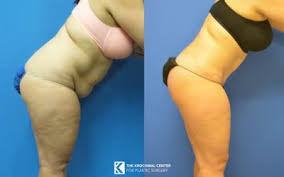 Take certain medications or adjust your current medications. Chicago And Oak Brook Tummy Tuck Krochmal Plastic Surgery