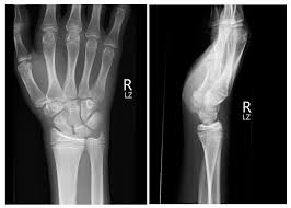 Image result for Pisiform Bone