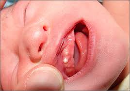 Image result for Neonatal Teeth