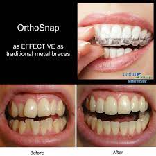 We did not find results for: How To Straighten Your Teeth Without Braces Or Aligners Arxiusarquitectura