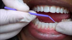 It may just take a little practice and some good dexterity. 139 Fixing Issue With Permanent Retainers On My Teeth Youtube