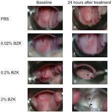Image result for Colposcopy Findings