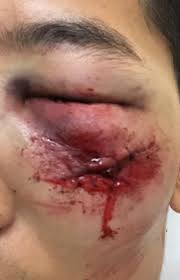 Loosen tight clothing and drape him in a blanket or coat. Protestor S Face Severely Wounded After Being Grazed By Rubber Bullet Warning Graphic Content Dimsum Daily