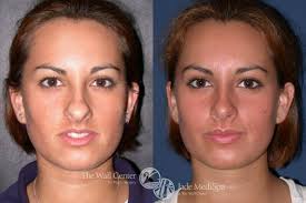 Rhinoplasty Before and After Pictures Case 857