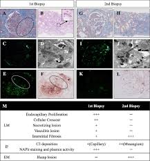 The main symptoms are blood in your child's wee and swollen ankles or puffy. Crescentic Poststreptococcal Acute Glomerulonephritis Accompanied By Small Vessel Vasculitis Case Report Of An Elderly Male Bmc Nephrology Full Text