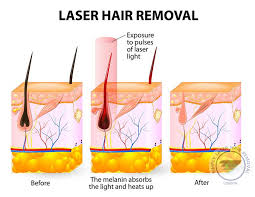 Hair generally grows all over the human body, some fine and barely noticeable, with other areas having thicker, more prominent hair. Laser Hair Removal London Simply Laser Hair Removal