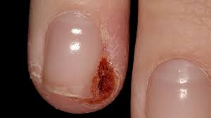Image result for paronychium