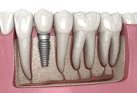 Dental implant - Wikipedia