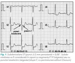 Cand conducerea este intarziata in ventriculul drept se produce blocul de ramura drept, iar. Testul De Efort Ecg De La TehnicÄ La Efort Stetoscopcardio