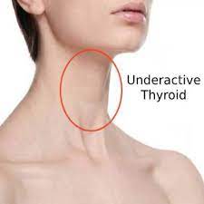 Thyroid dysfunction is another possible cause of hair loss. Can Obesity Cause Hair Loss Ahs India