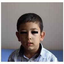 a) The boy, before carnitine treatment with significant mask face and...