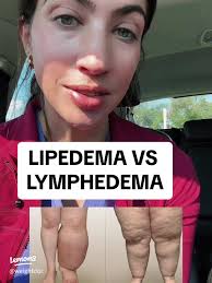 Signs of Lipedema: Identifying Symptoms and Understanding This Condition