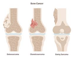 Image result for Osteosarcoma