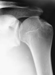 Achetez des vinyles & cds et complétez votre collection hagl. Radiograph Showing The Appearance Of Hagl With A Scalloped Medial Neck Download Scientific Diagram