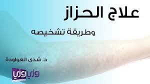 علاج الحزاز وطريقة تشخيصه youtube
