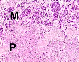 Sarcomatoid mesothelioma shows more bland spindle cell proliferation admixed with inflammatory cells. Pathology Outlines Diffuse Malignant Mesothelioma
