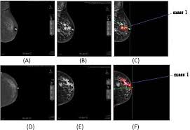 Naming the quadrants for the purpose of describing a lump  or 1. Figure 8 From Computer Assisted Surgery And Therapy Cast For Breast Masses Based On Mammography Semantic Scholar