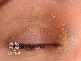 Image result for milium cyst on eyelid
