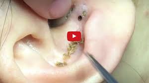 If you have chronic ringing in your ears, try taking gingko extract 3 times a day with your meals which may help reduce the ringing. Watch Blackheads Being Removed From The Inside Of Someone S Ear Allure