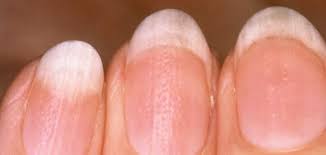 ظهور خط احمر غاااامق : Ø£Ø³Ø¨Ø§Ø¨ ØªØºÙØ± ÙÙÙ Ø§ÙØ£Ø¸Ø§ÙØ± ÙÙØ¶ÙØ¹